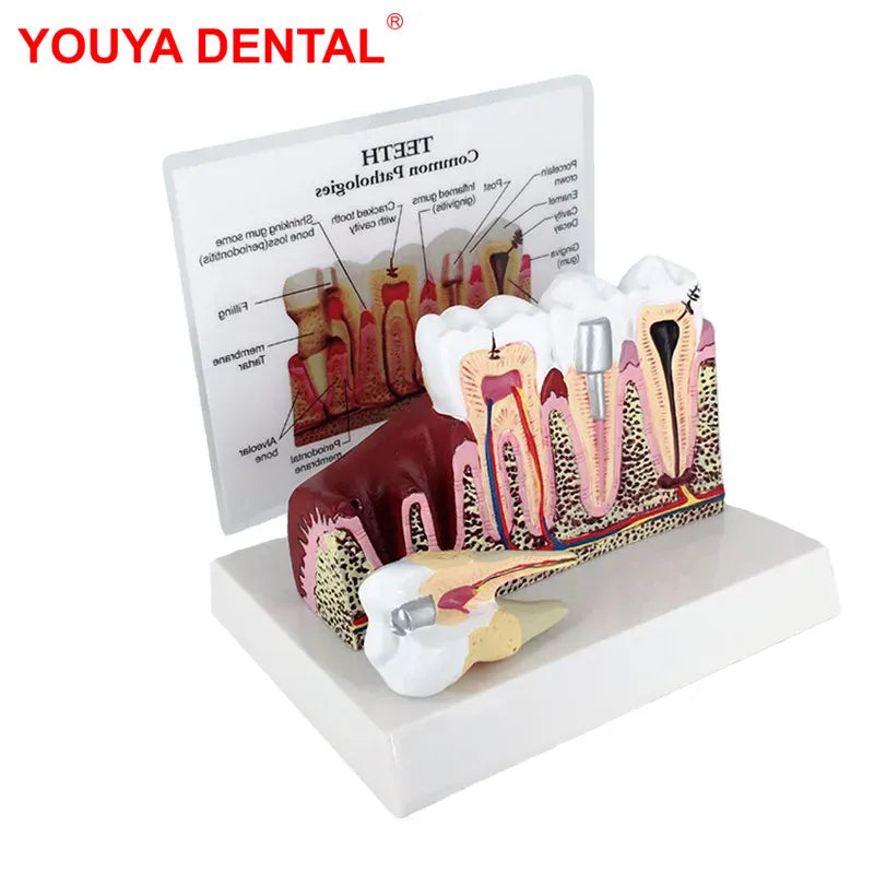 Trendzoy 1pcs Fully Anatomical Teeth Model For Studying Teaching Demonstration Dentist Dental Models For Patient Education Dentistry Products