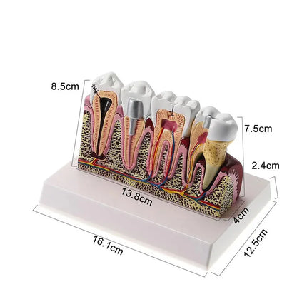 Trendzoy 1pcs Fully Anatomical Teeth Model For Studying Teaching Demonstration Dentist Dental Models For Patient Education Dentistry Products